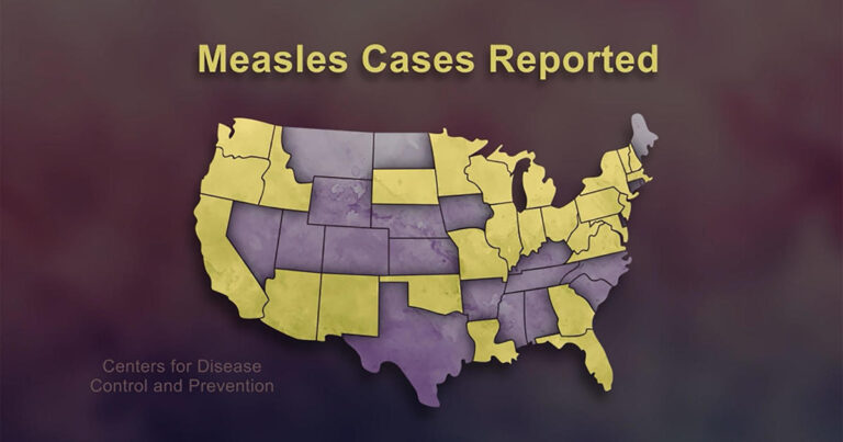 measles cases reported 1920